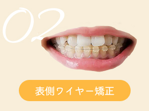 表側ワイヤー矯正