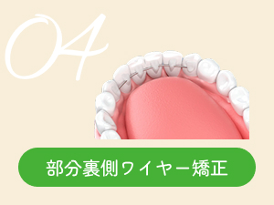 部分裏側ワイヤー矯正