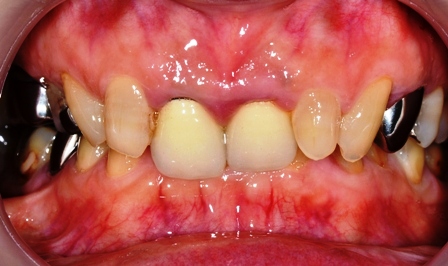 銀歯１.JPGのサムネール画像