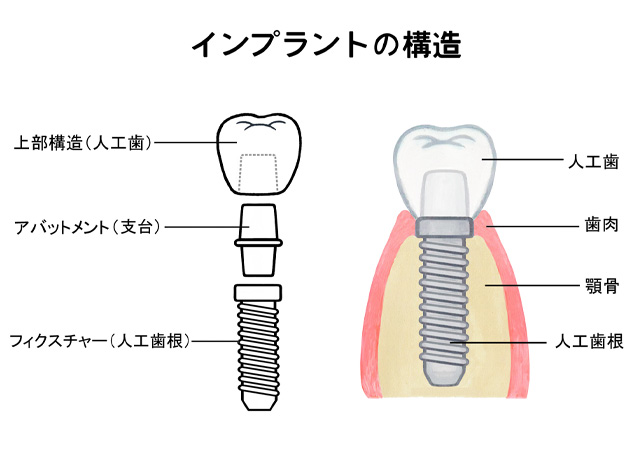 インプラントの構造を説明したイラスト