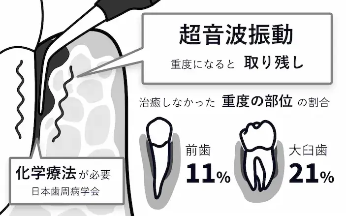 超音波振動のみ