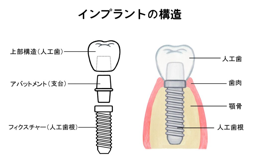 インプラント構造を解説する図解イラスト